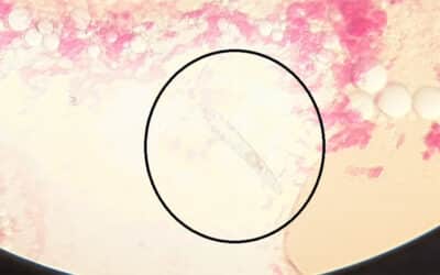 The Mighty Mite That is Not so Mighty: Demodex